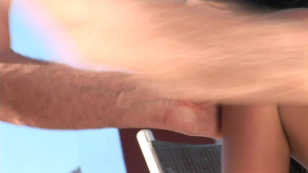 Anal HDV127