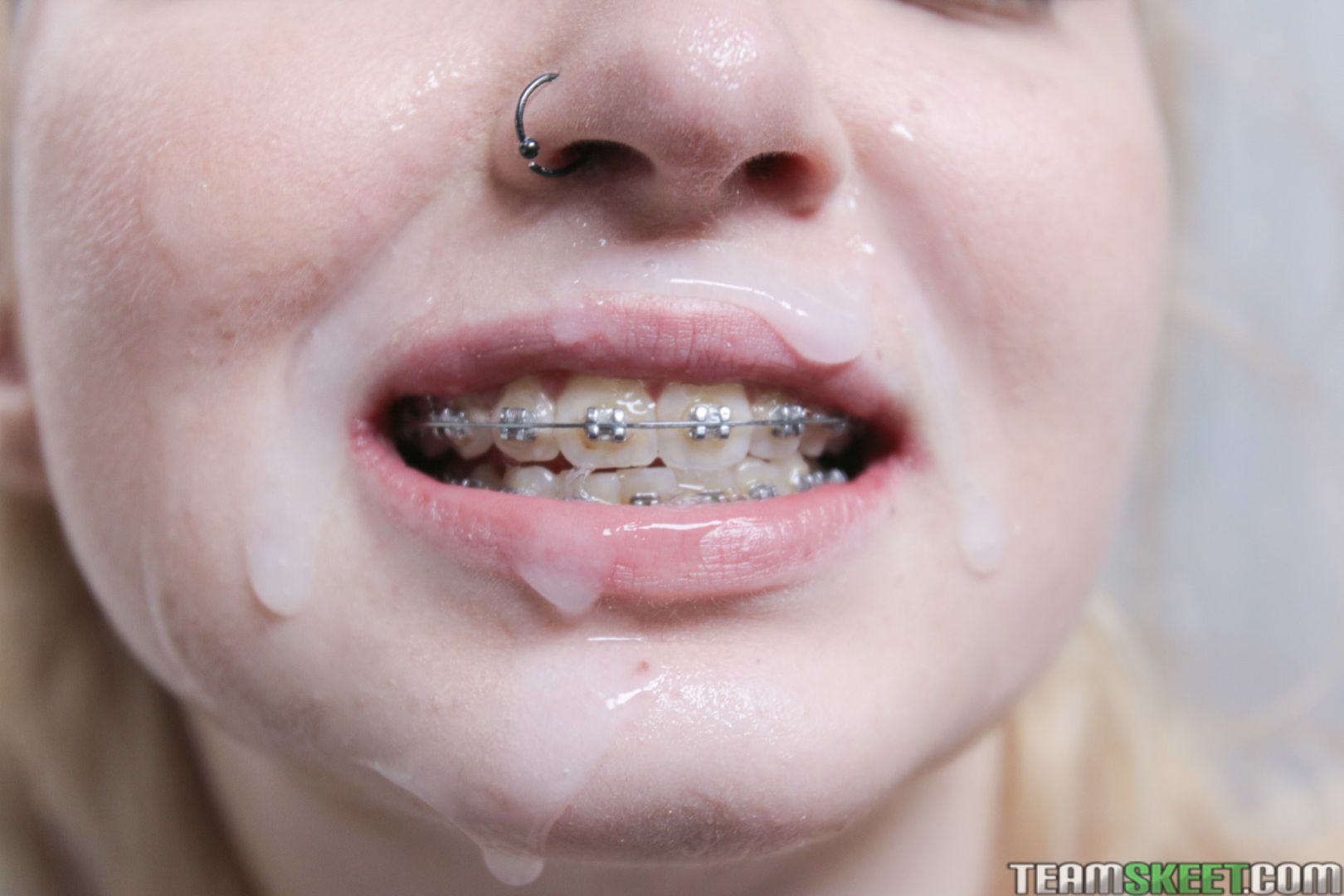 The Bracefaced Hook Up