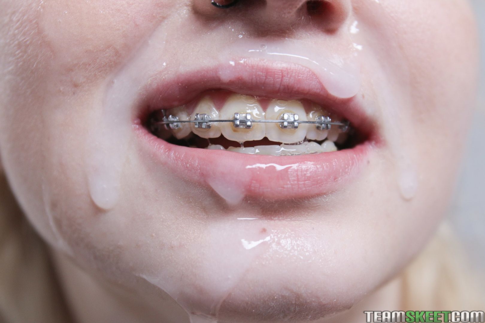 The Bracefaced Hook Up