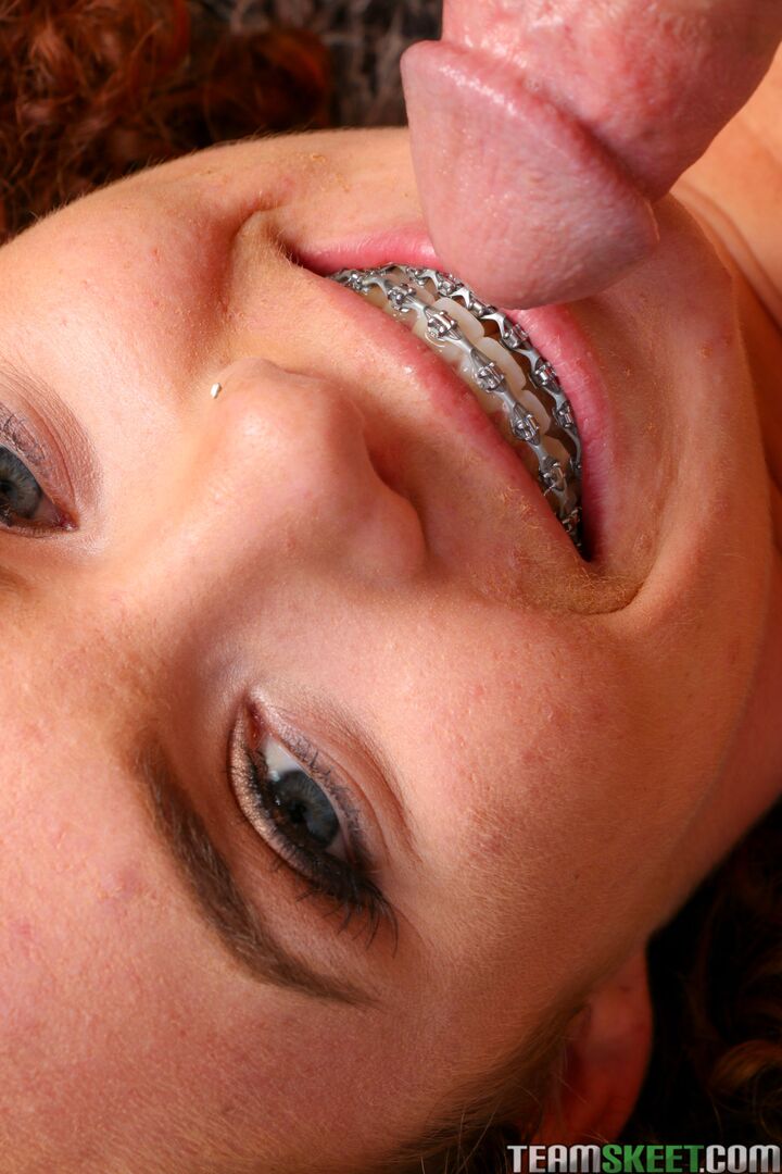 Beautiful Blinding Braces