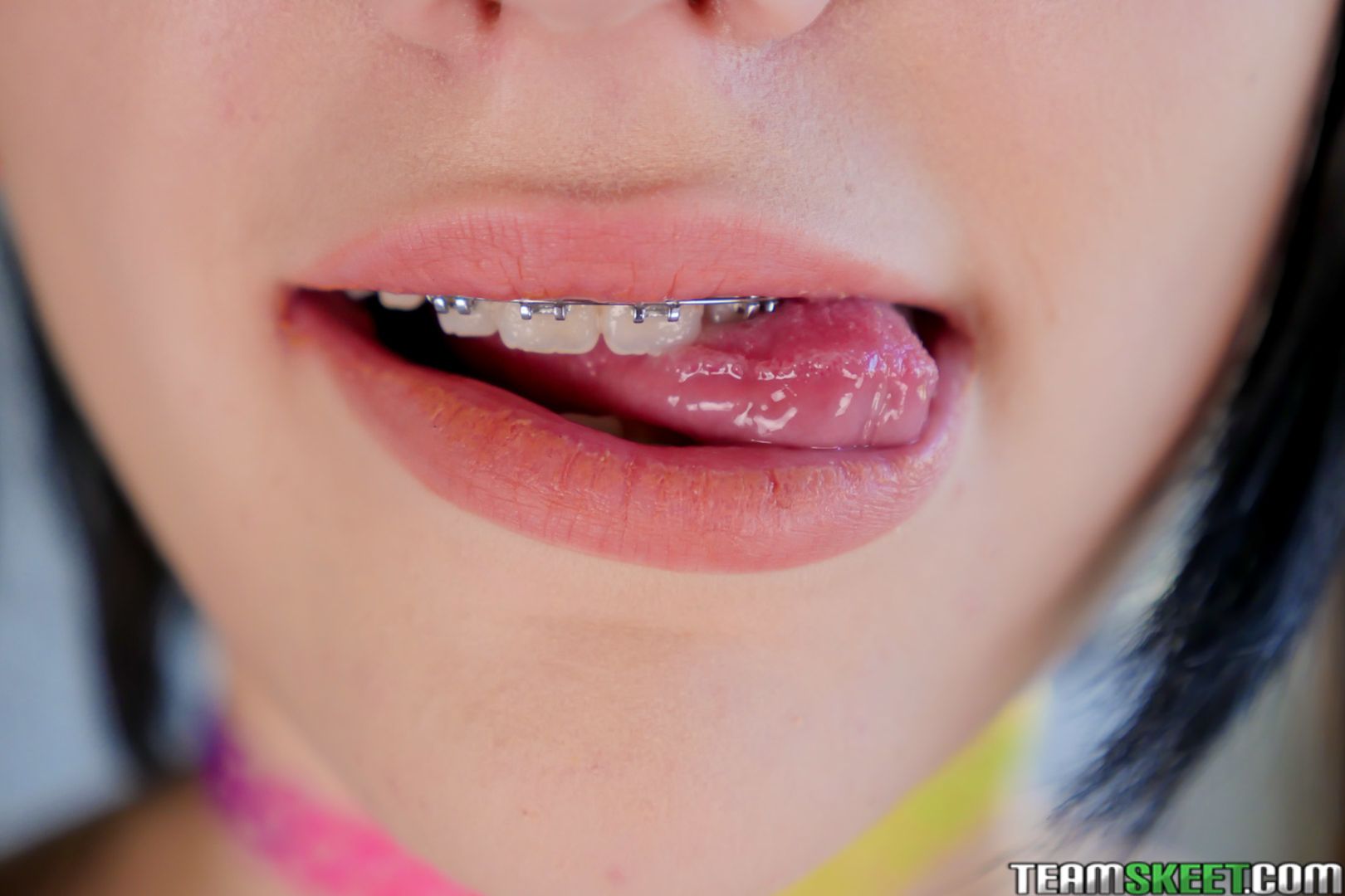 The Original Brace Face